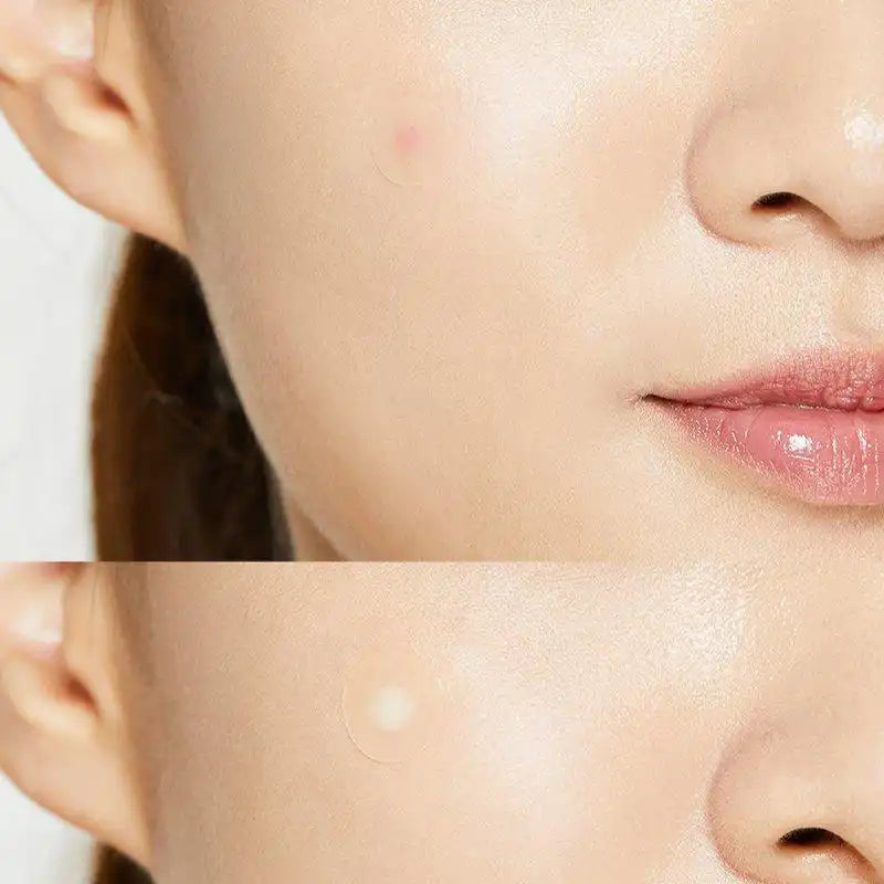 COSRX - Acne Pimple Master Patch